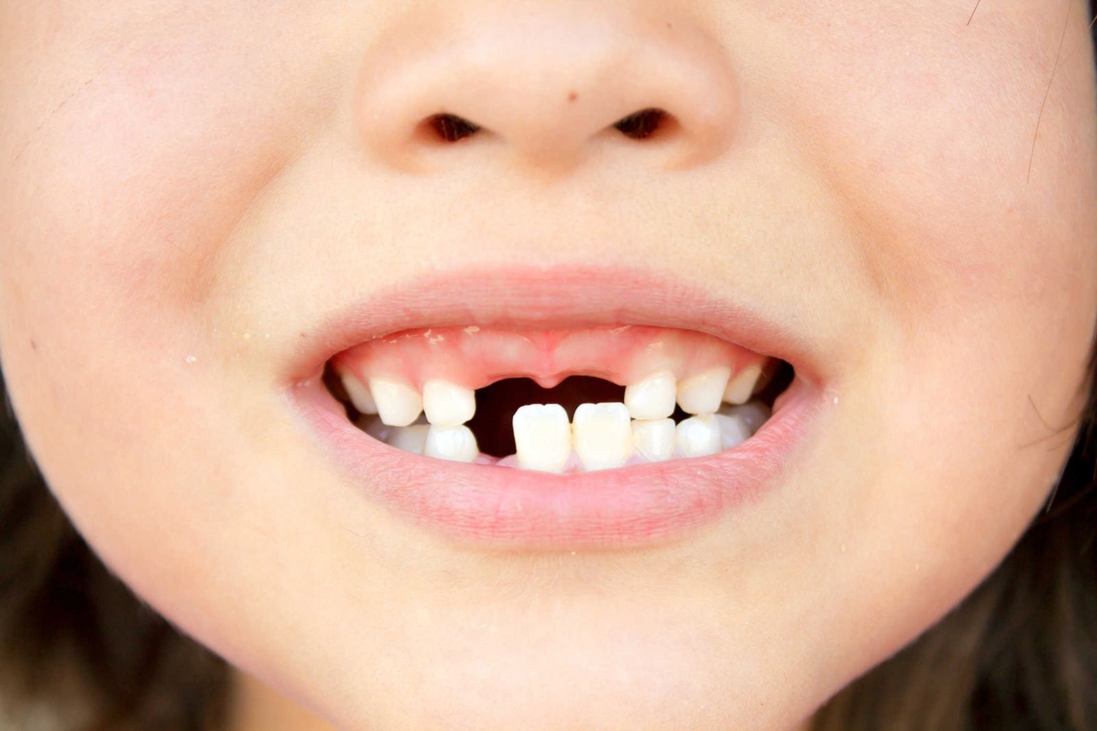 Nguyên nhận khiến trẻ bị sún răng 1
