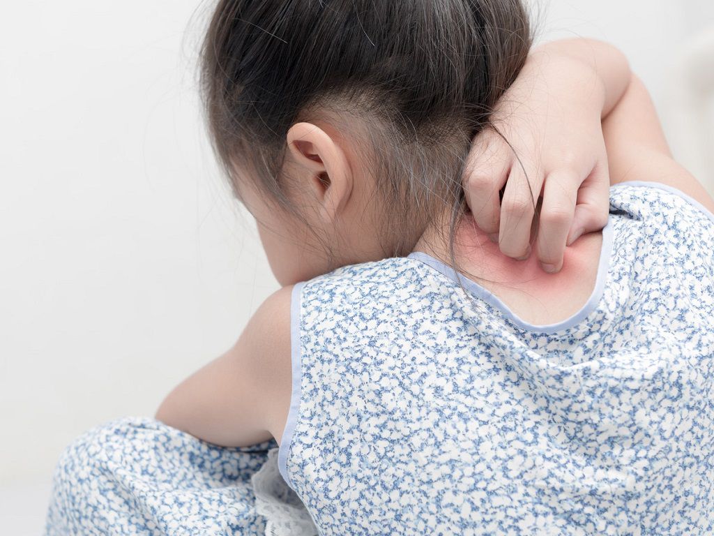 3 bệnh dị ứng của trẻ em thường gặp nhất và cách điều trị 3