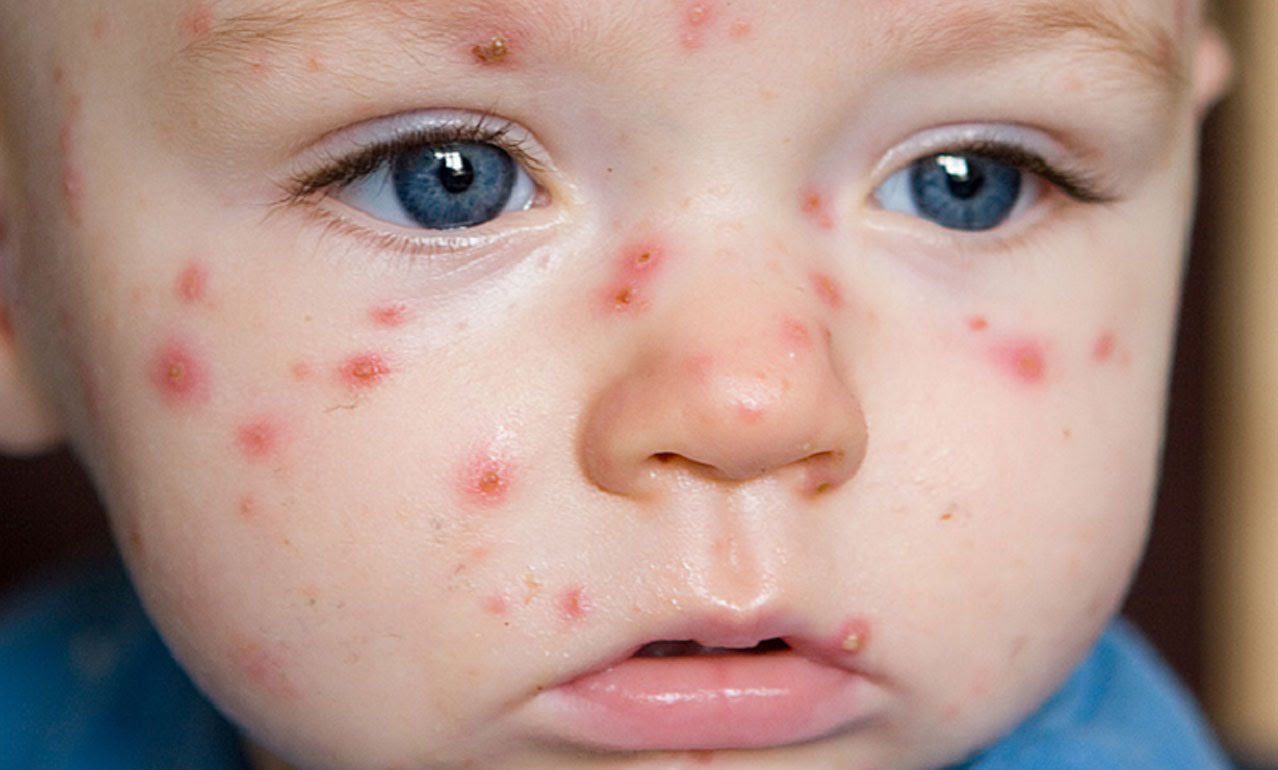 Bệnh sởi measles ở trẻ em 3
