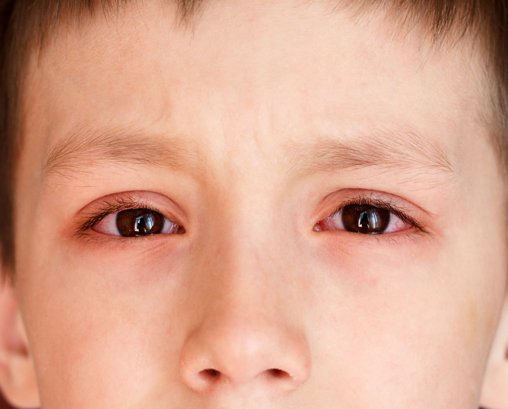 Dấu hiệu đau mắt đỏ ở trẻ em và cách điều trị 2