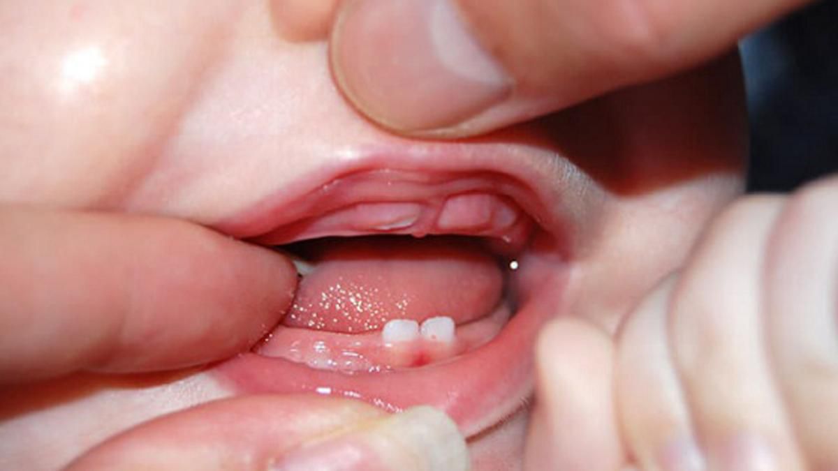 Thời điểm trẻ mọc răng hàm và cách khắc phục cơn đau răng 2