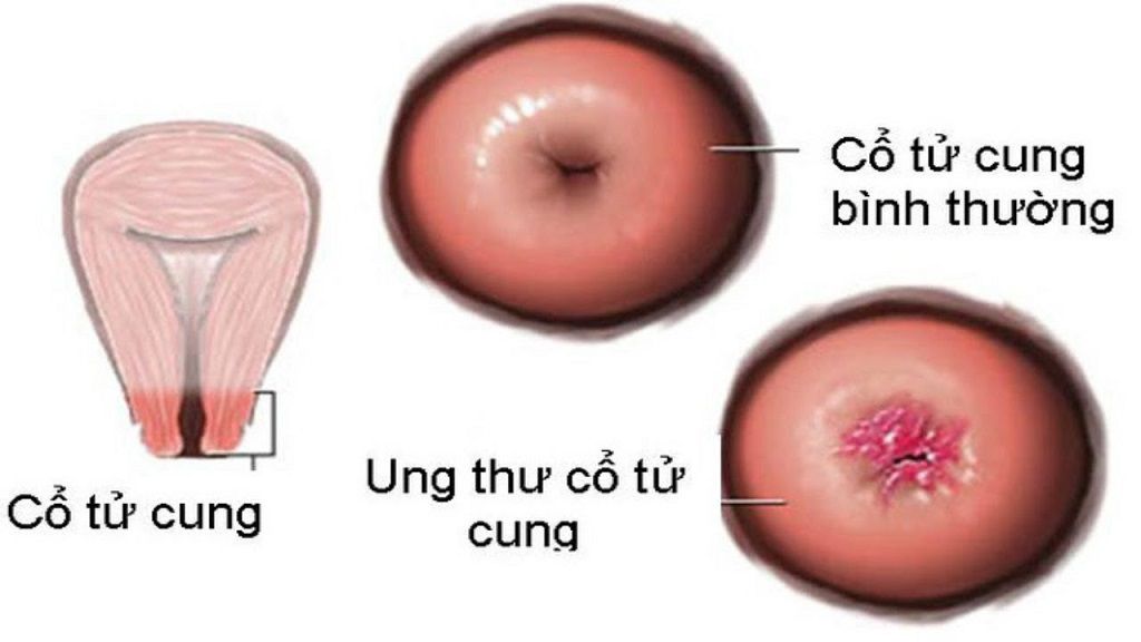 Ung thư cổ tử cung di căn hạch: Nguyên nhân và cách điều trị 1